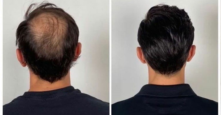 Hair Weaving Service in Bharuch-Gujarat